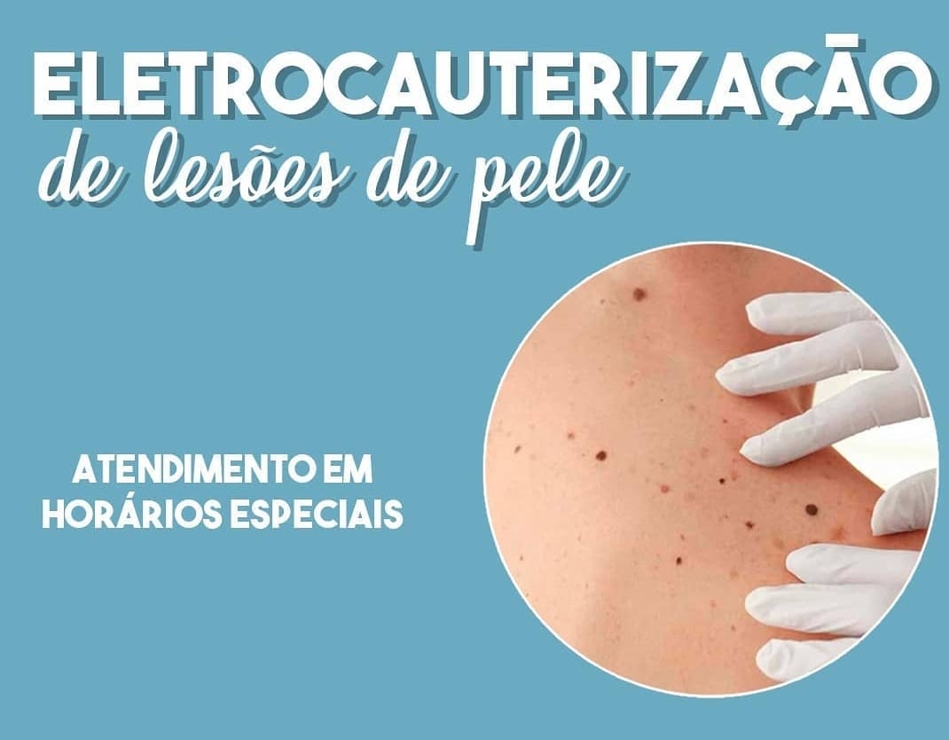 RETIRADA DE PEQUENAS LESOES DE PELE
